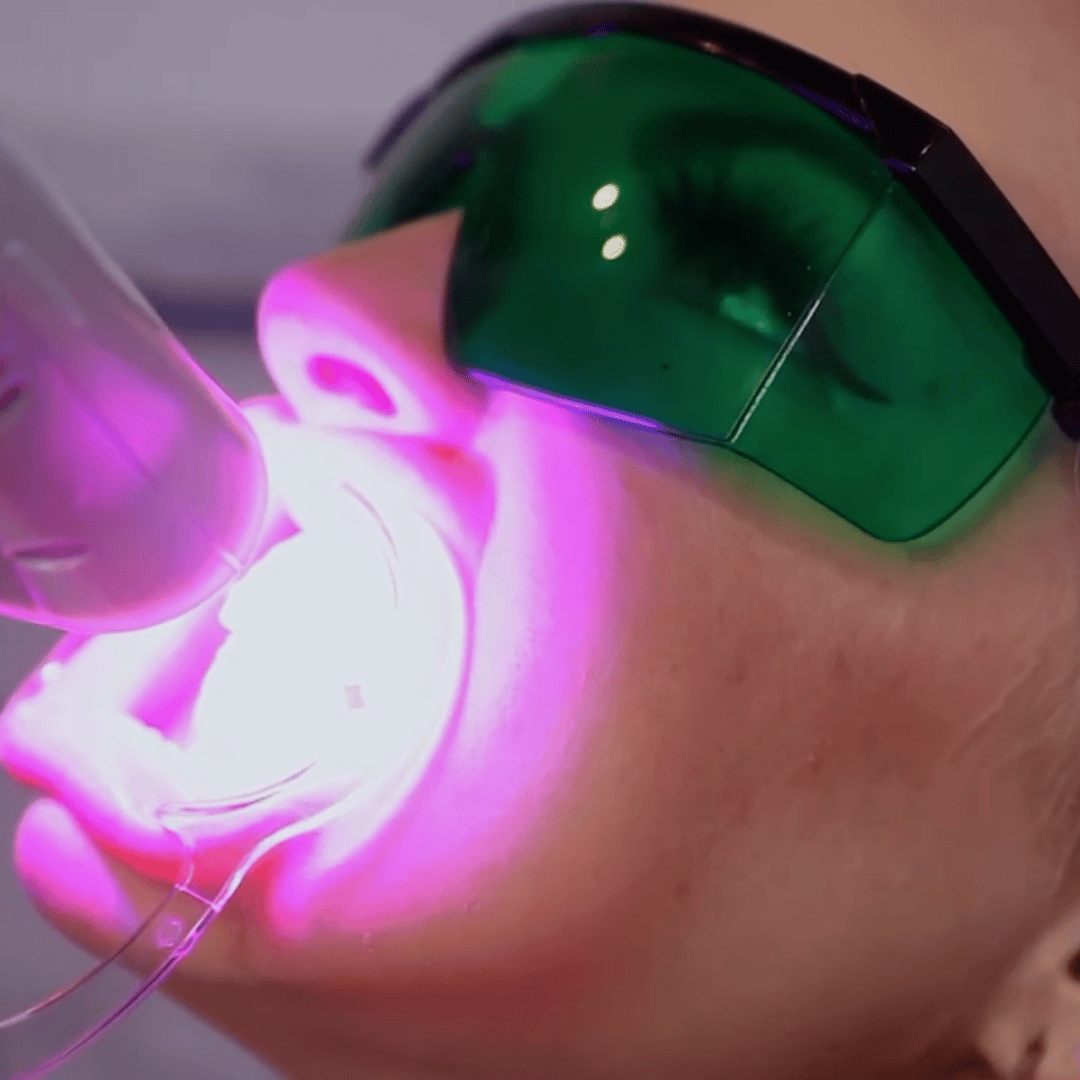 What is Laser Teeth Whitening?
