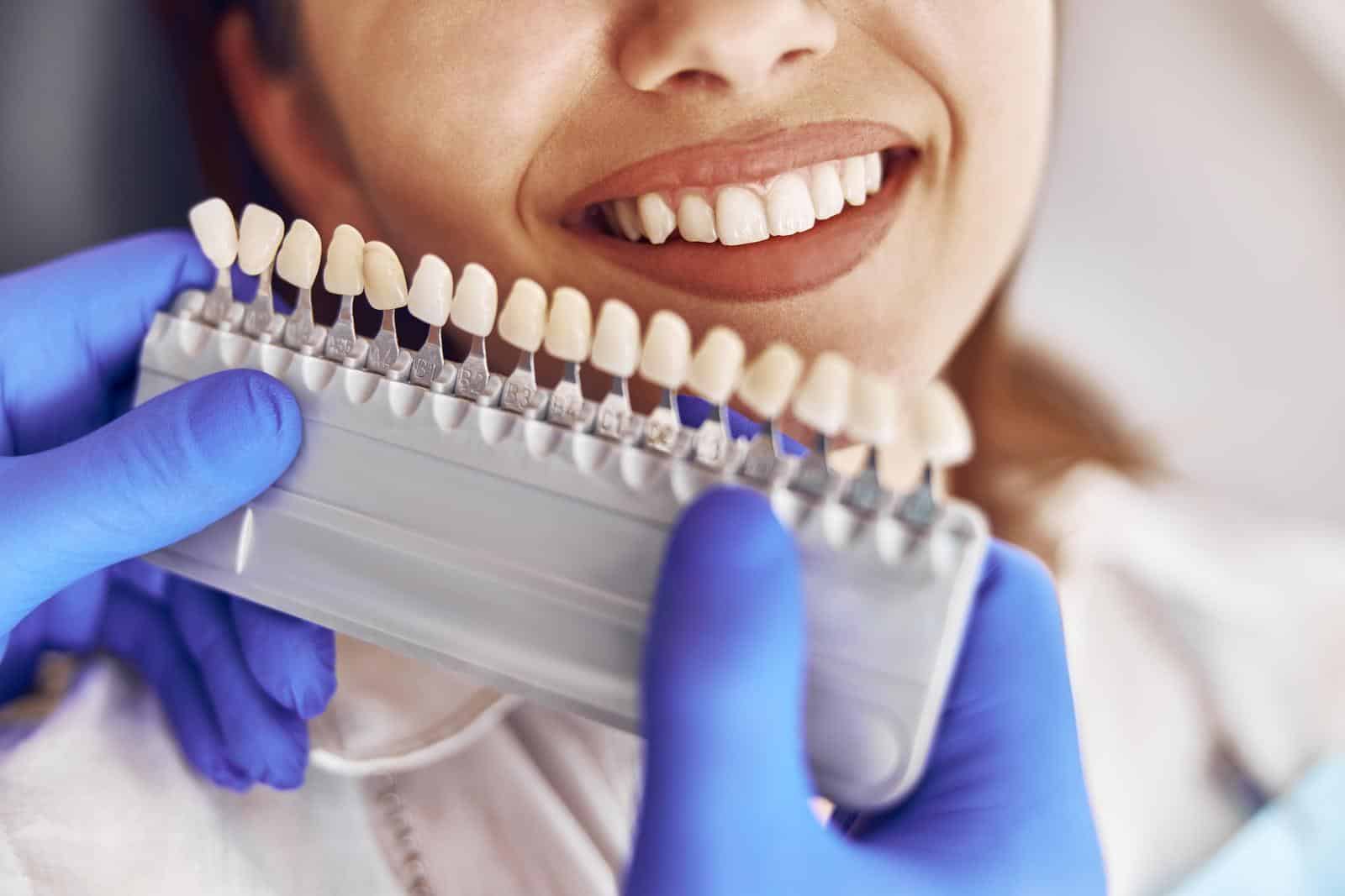 Do-It-Yourself vs. Professional Teeth Whitening