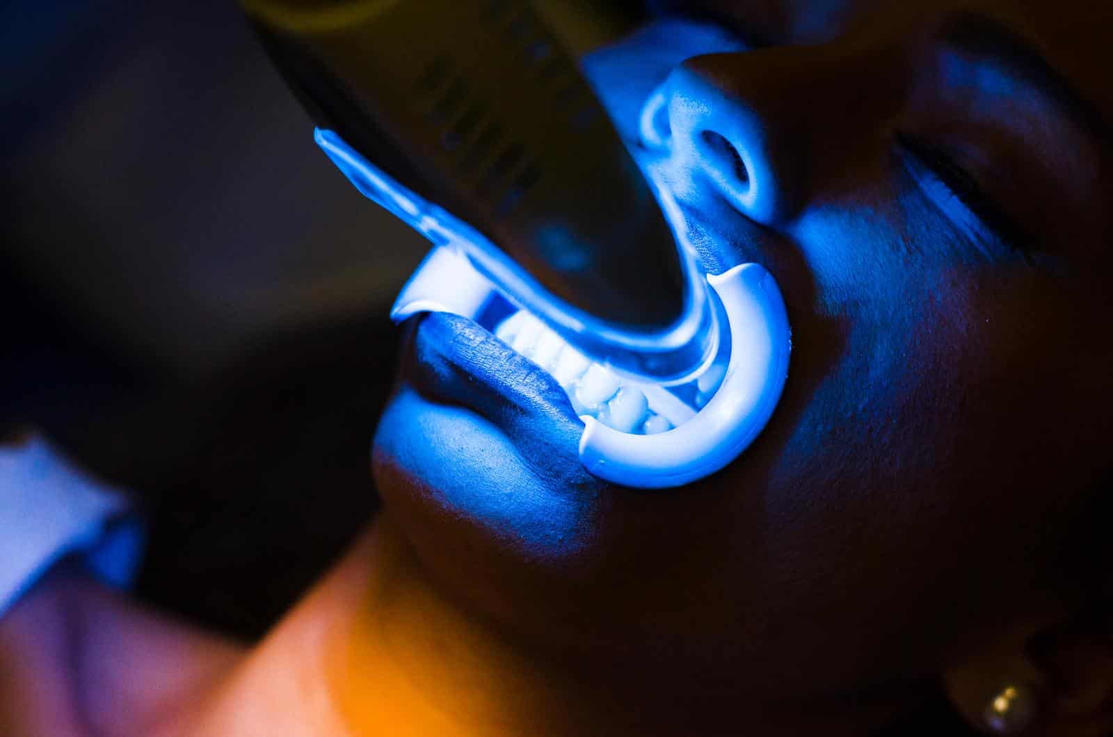How Teeth Whitening Light Works and Why It’s Changing Smiles
