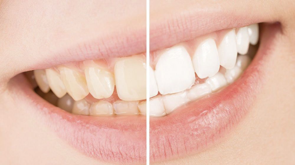 Teeth Whitening in San Antonio: Why Choose a Specialist at We Whiten