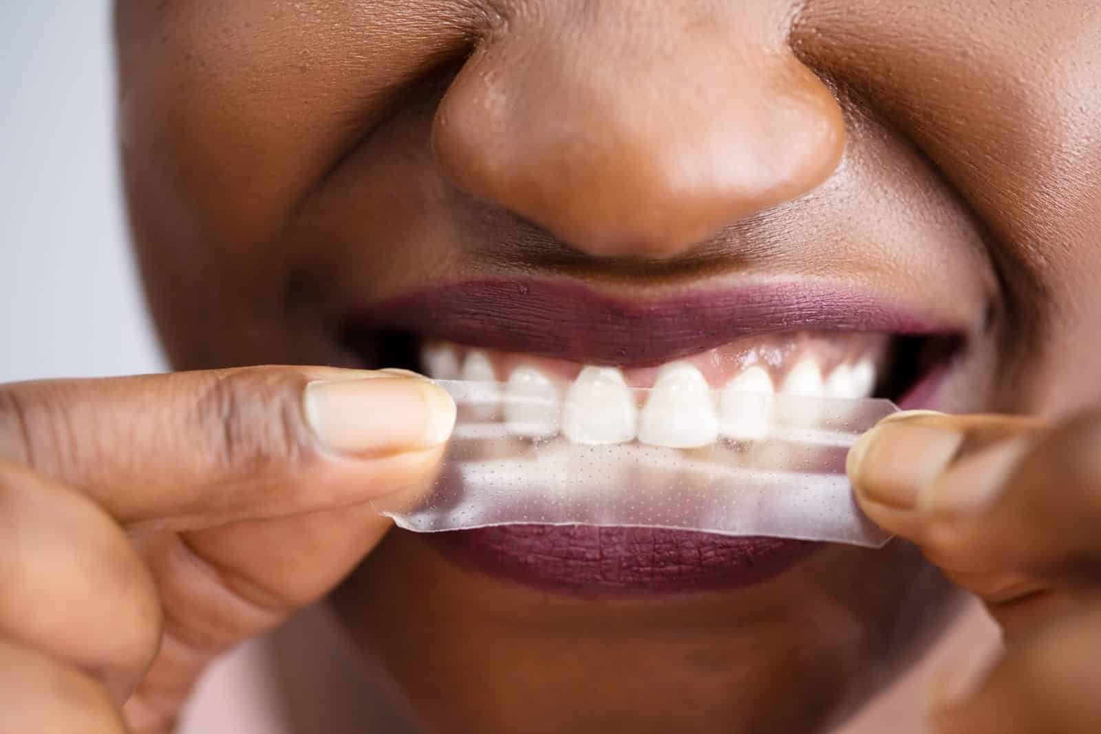 Professional Teeth Whitening vs Whitening Strips