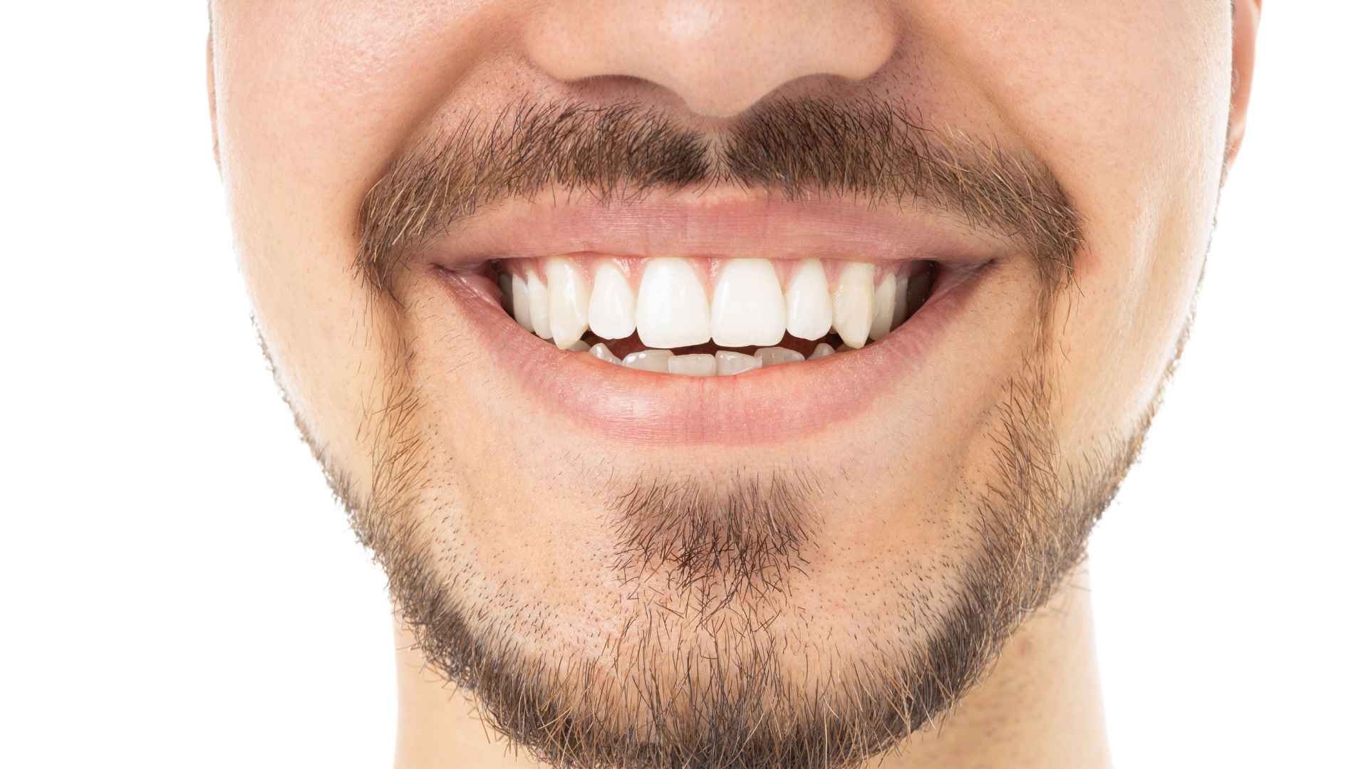 How to Remineralize Your Teeth After Whitening: A Complete Guide