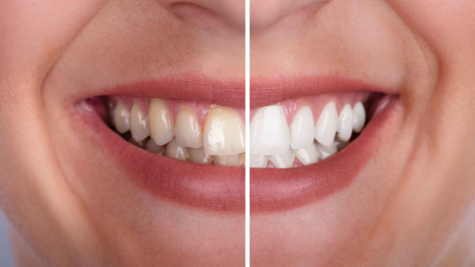 Teeth Whitening Services Explained: Comparing Your Options at We Whiten
