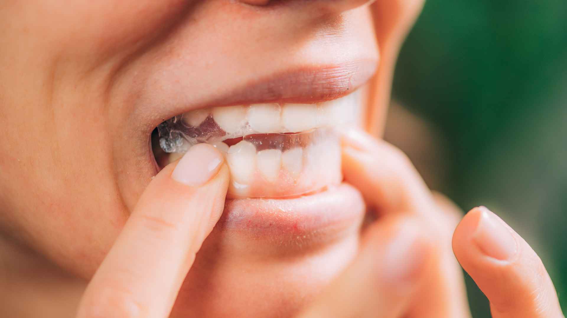 Whitening Strips: Do They Work, Are They Safe, and How Should You Use Them?